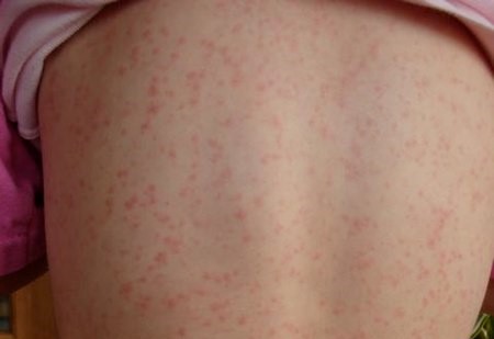 Scarlet fever - Wikipedia